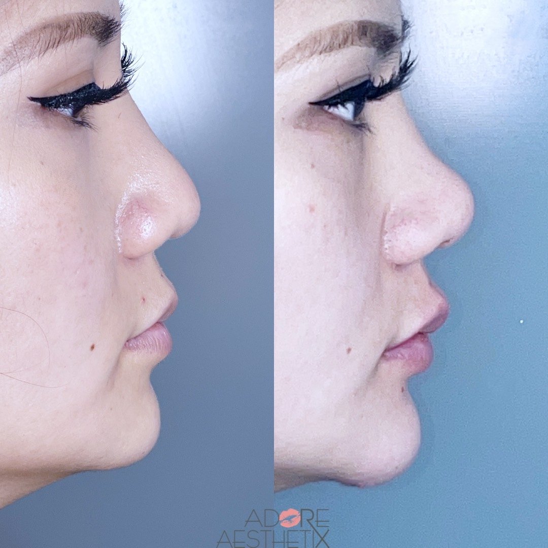 Restylane-L For Nose