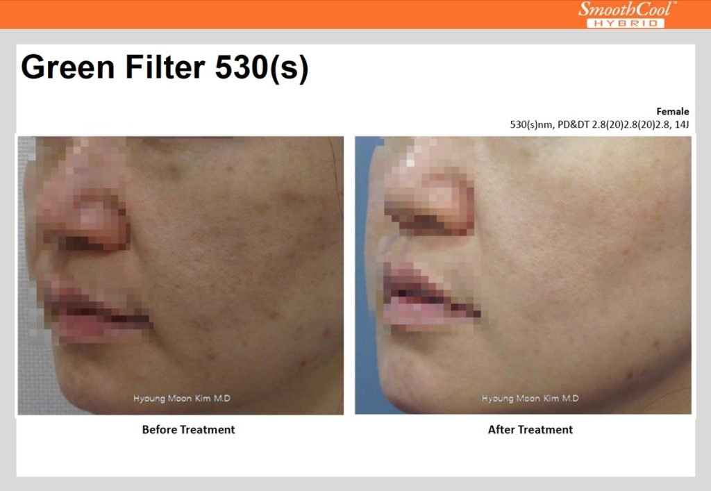 Hyperpigmentation